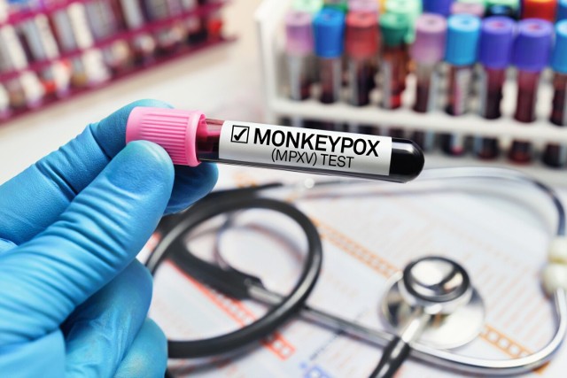 Już wkrótce szybki test PCR wykrywający zakażenie małpią ospą będzie można wykonać w Polsce. Obecnie próbki są wysyłane za granicę, a na wynik trzeba czekać 10 dni.