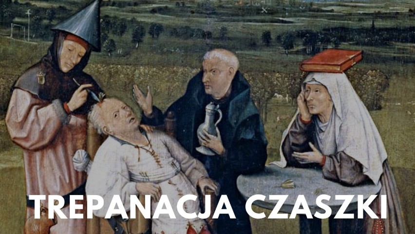 Zabieg trepanacji polega na wykonaniu otworu w czaszce...