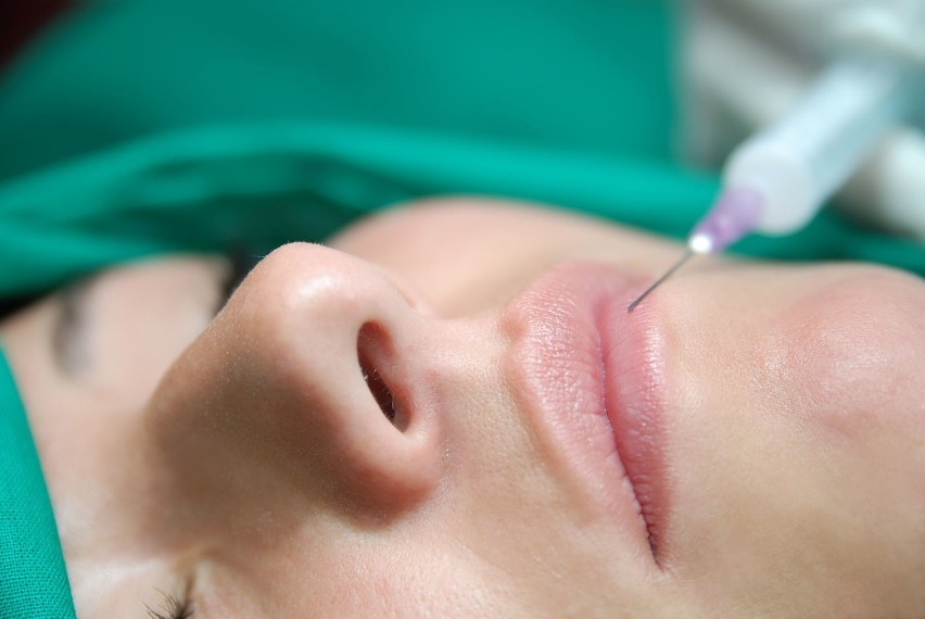 Medycyna estetyczna - powiększanie ust kwasem hialuronowym