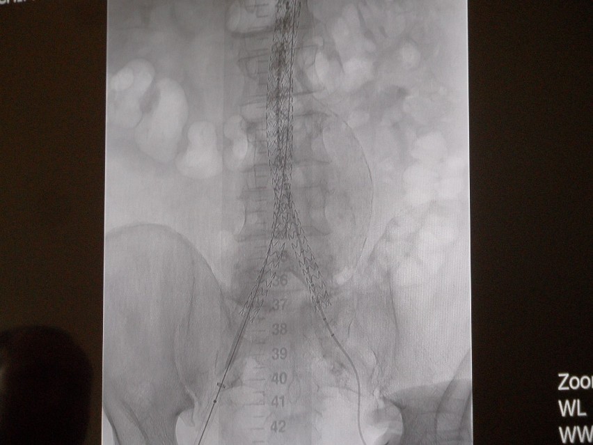 Szpital nr 4 Bytom : Nowatorskie operacje pod znakiem zapytania. Wycena stentgraftów nieadekwatna