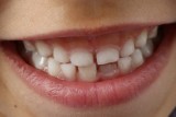 Bezpłatne przeglądy dentystyczne dla dzieci - rusza białostocka Akademia Zdrowego Uśmiechu