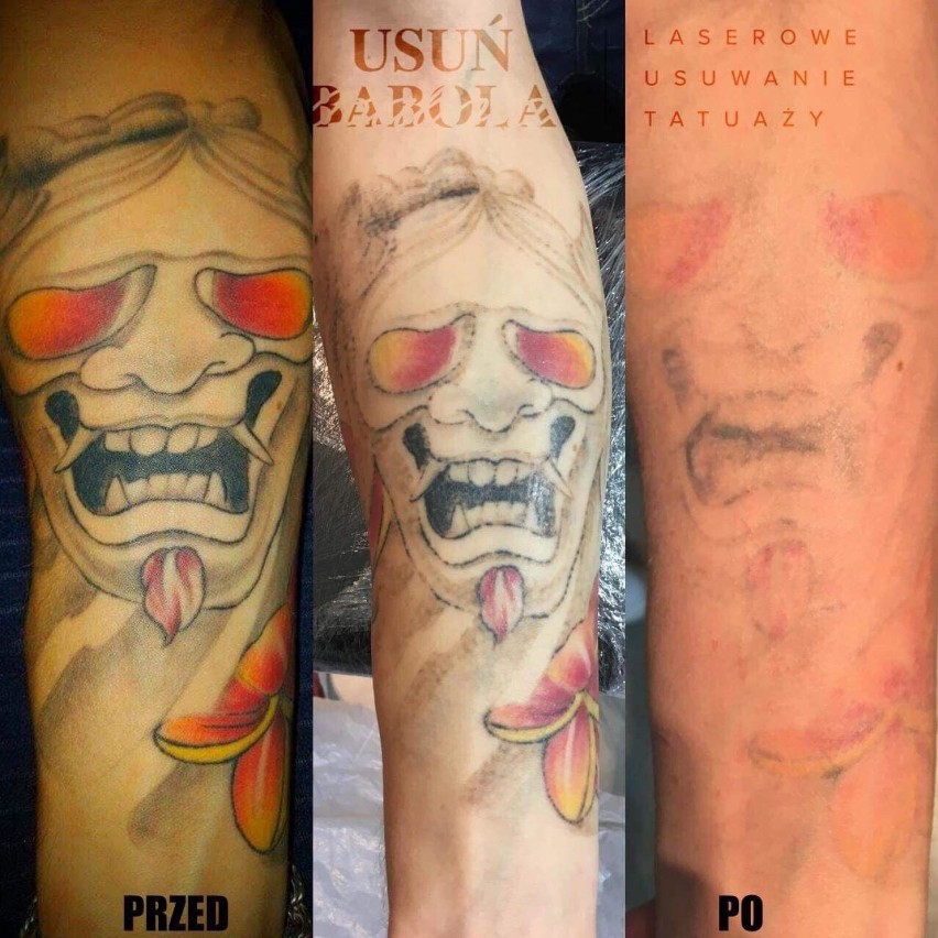 Tatuaż przed i po zabiegach laserem.