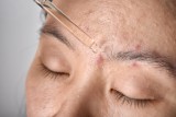 Kwas traneksamowy na twarz – jak działa nowy składnik kosmetyczny? Sprawdzi się właśnie teraz! Usuwa nie tylko przebarwienia słoneczne