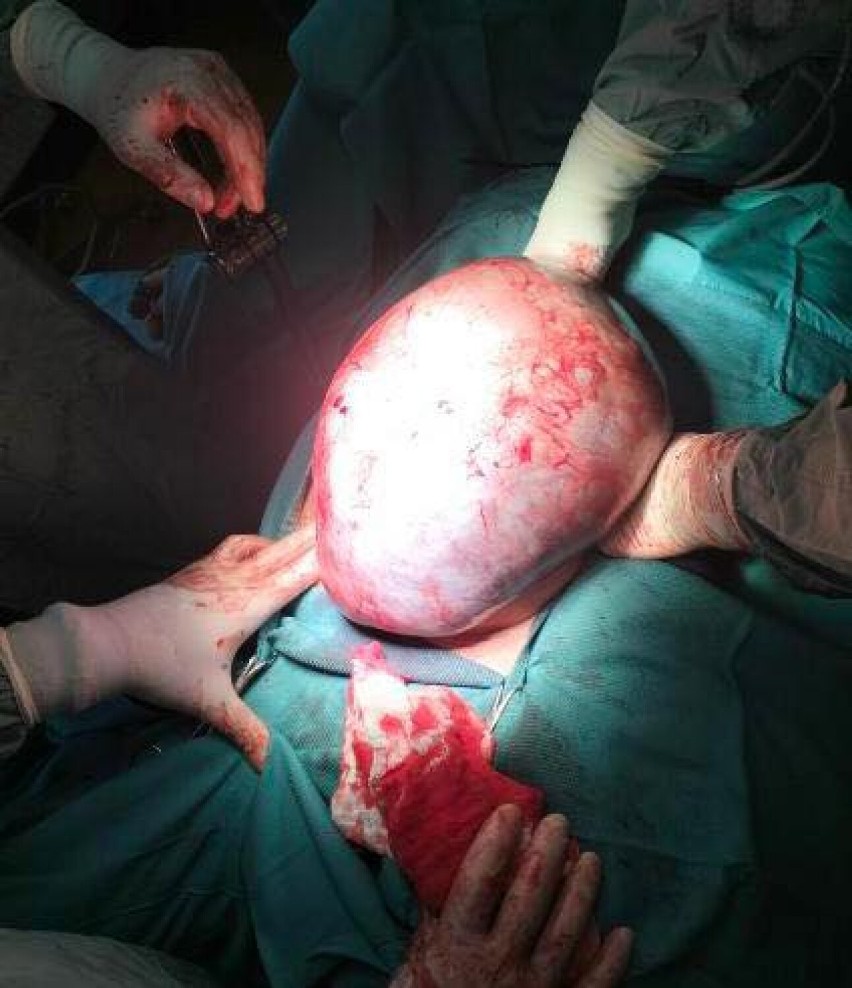 W kaliskim szpitalu usunięto wielki guz jajnika. Lekarze przypominają o badaniach profilaktycznych. ZDJĘCIA